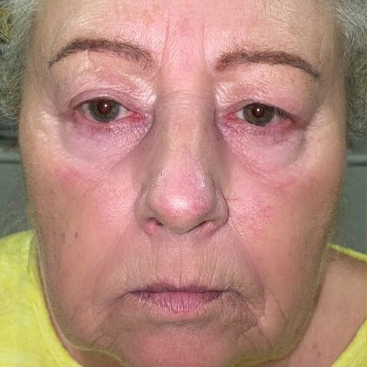 Thread Face lift