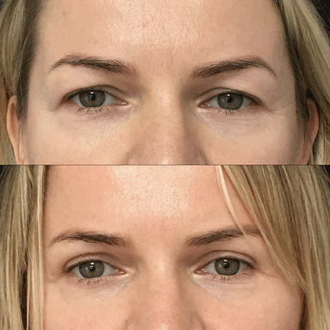 Blepharoplasty Liverpool