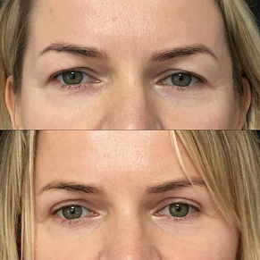 upper blepharoplasty Liverpool Before and after images