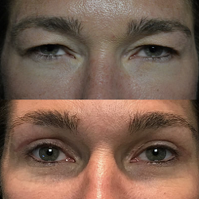upper blepharoplasty Liverpool Before and after images