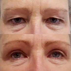 upper blepharoplasty Liverpool Before and after images