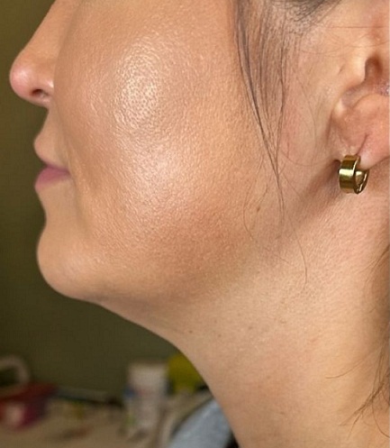 skin tightening