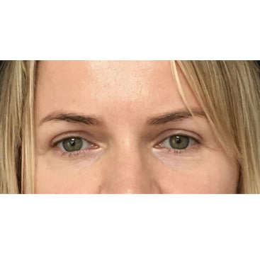 Blepharoplasty