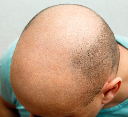 The,Head,Of,A,Balding,Man,Before,And,After,Hair