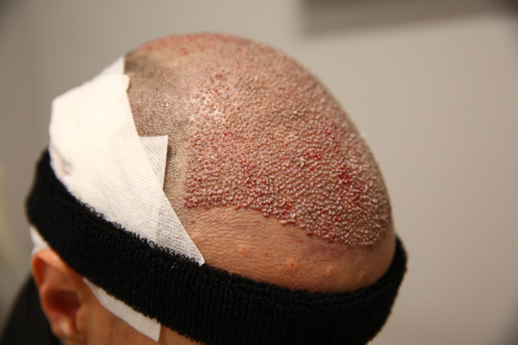 Hair Transplant costsLiverpool