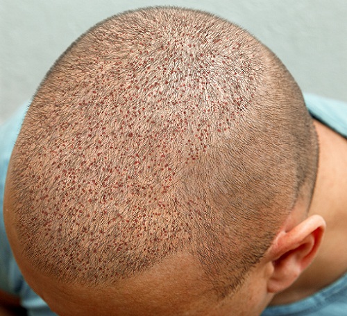 The,Head,Of,A,Balding,Man,Before,And,After,Hair