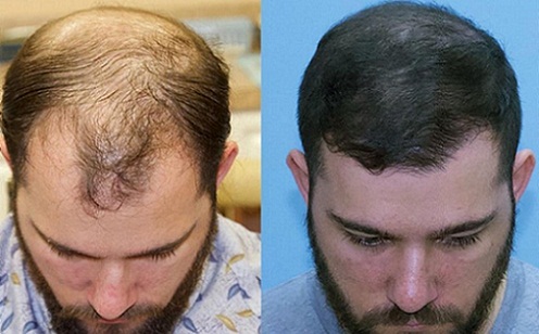 best hair transplant Liverpool