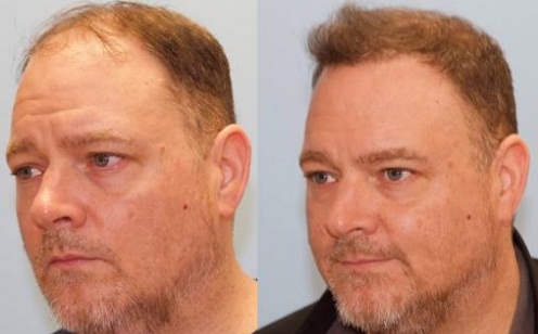 liverpool hair transplant clinic