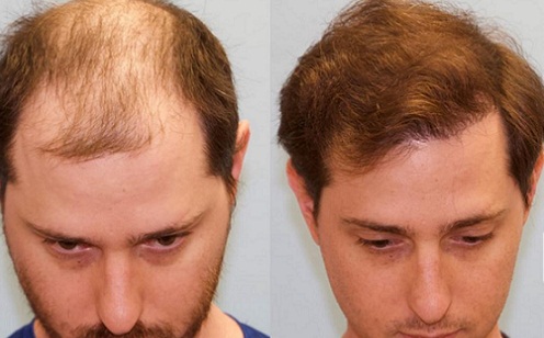 hair loss clinic Liverpool