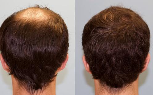 rose lane hair transplant Liverpool