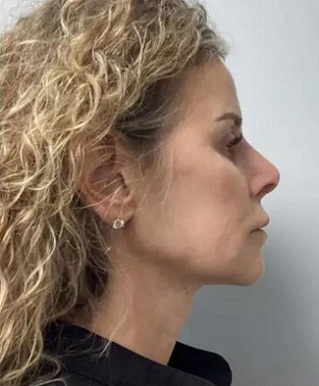 facial contouring face tite liverpool patient after image