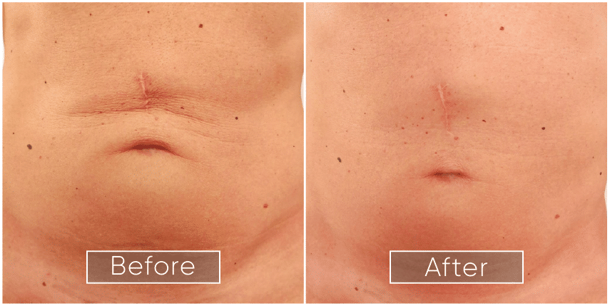 Before-and-After-Belly
