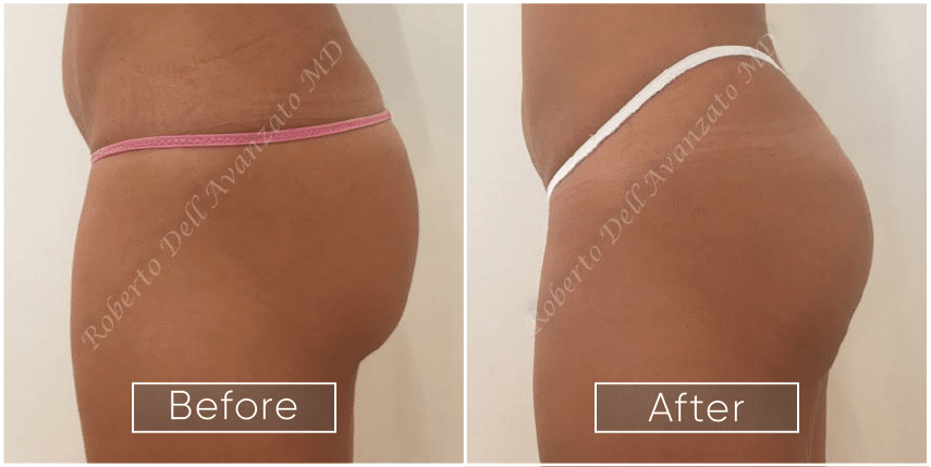 Before-and-After-Bum