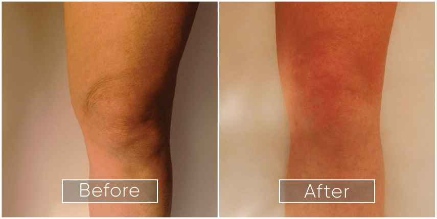 Before-and-After-Knee