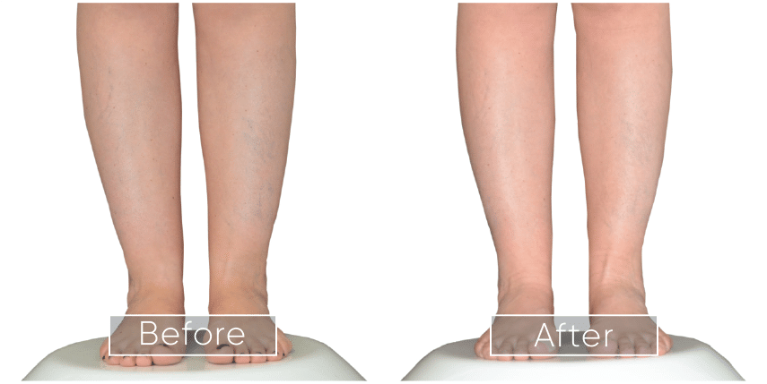 Before-and-After-Legs-1