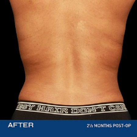 Skin Tightening