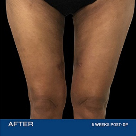 skin tightening