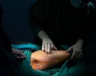 Liposuction