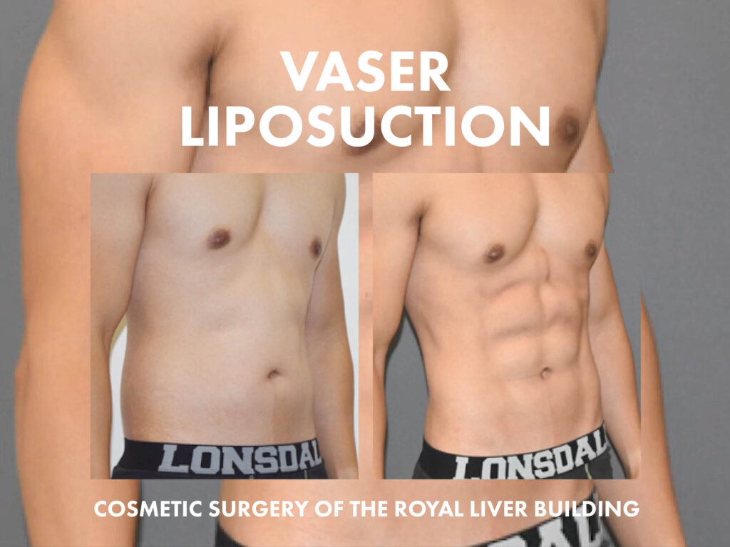 vaser liposuction liverpool before and after images