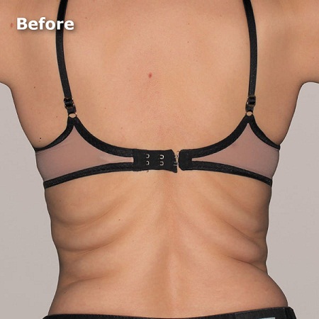 body contouring