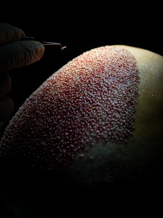 FUE hair transplant patient in action