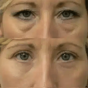 eyebag removal liverpool