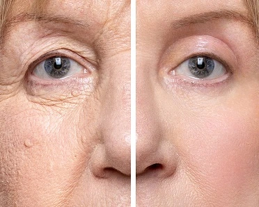 Upper Eyelid Surgery Liverpool