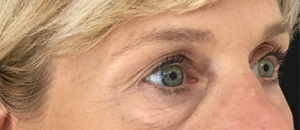 eye bag removal