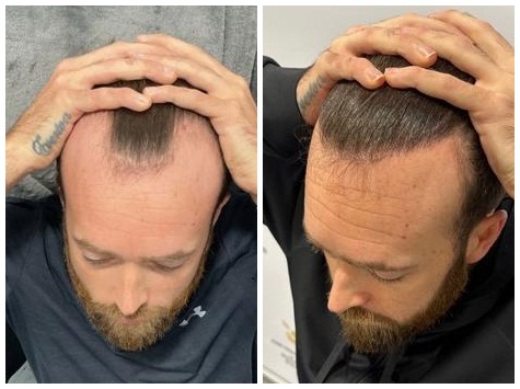 FUE hair transplant patient